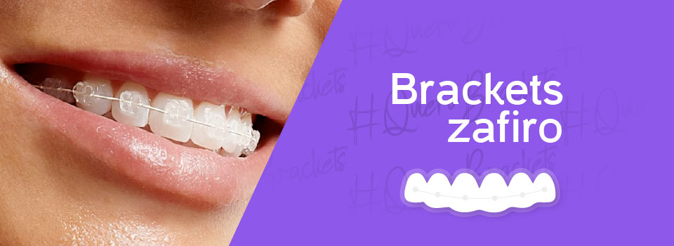 brackets de zafiro ó brackets transparentes