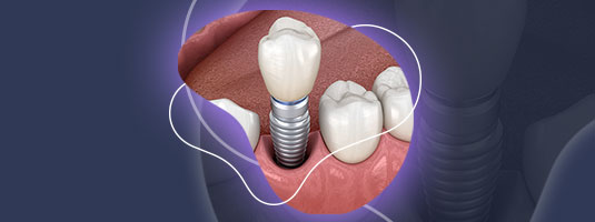Implantes dentales