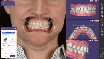 Diseño de sonrisa